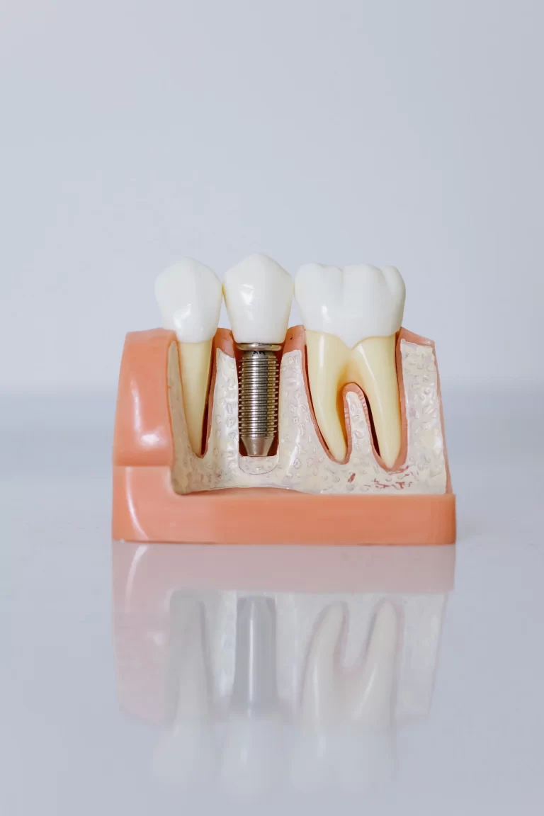 Model of a dental implant showing three teeth and a metal post within gum-like material.