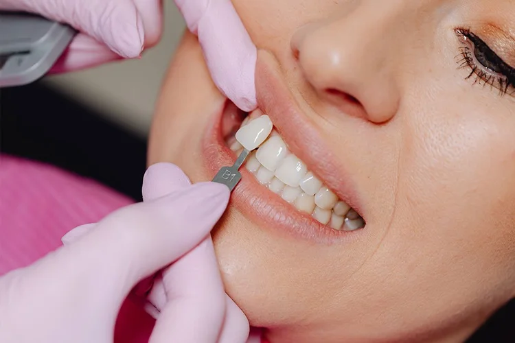 A dentist's gloved hand holds a shade guide next to a patient's smile to match tooth color for a dental procedure.