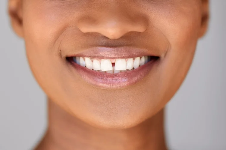 Close-up of a smiling person with straight, white teeth and a subtle gap in the front teeth against a neutral background.