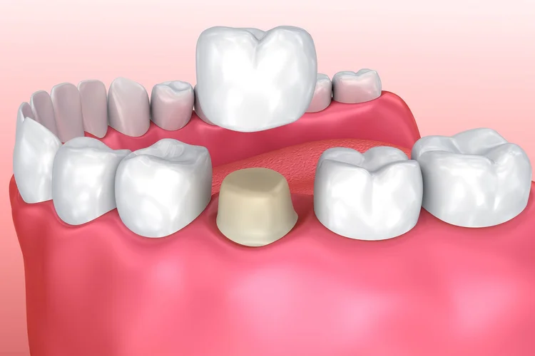 3D illustration of a dental crown placement on a tooth, surrounded by healthy teeth and gums.