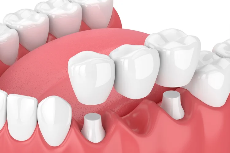 3D rendering of a jaw with white teeth and pink gums showcasing a dental bridge between two teeth.